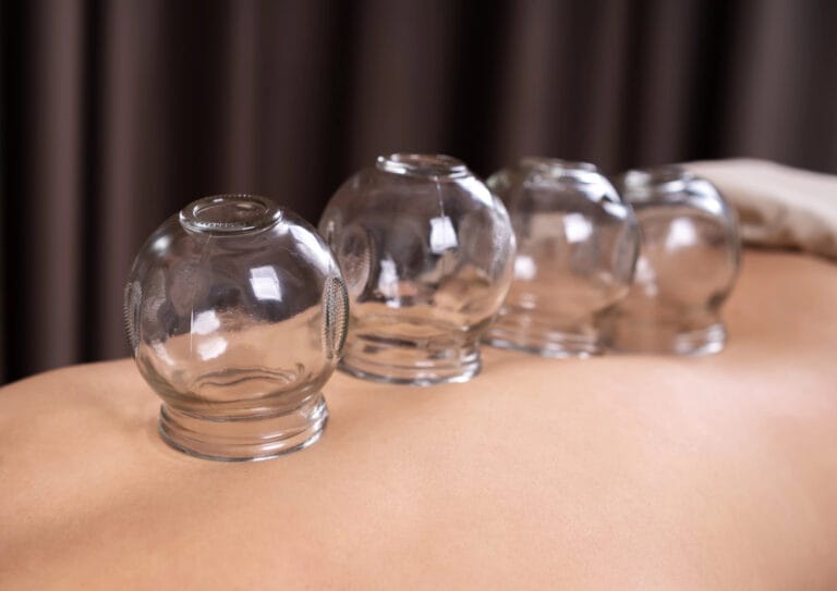 A Quick Guide to Cupping Therapy